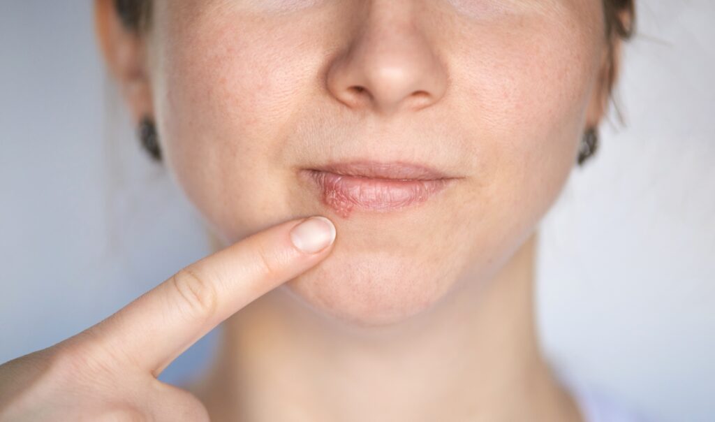 Closeup of a woman pointing to a cold sore at the edge of her mouth.
